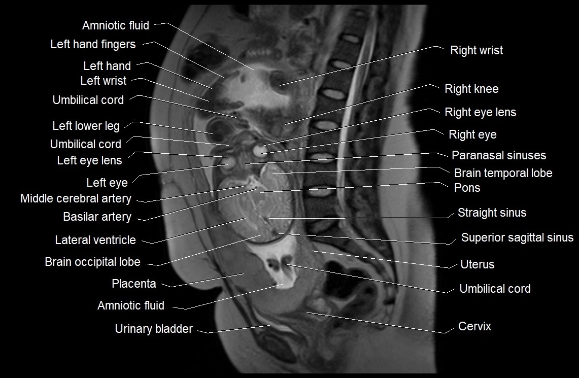 MRI fetal anatomy sagittal image 19.webp
